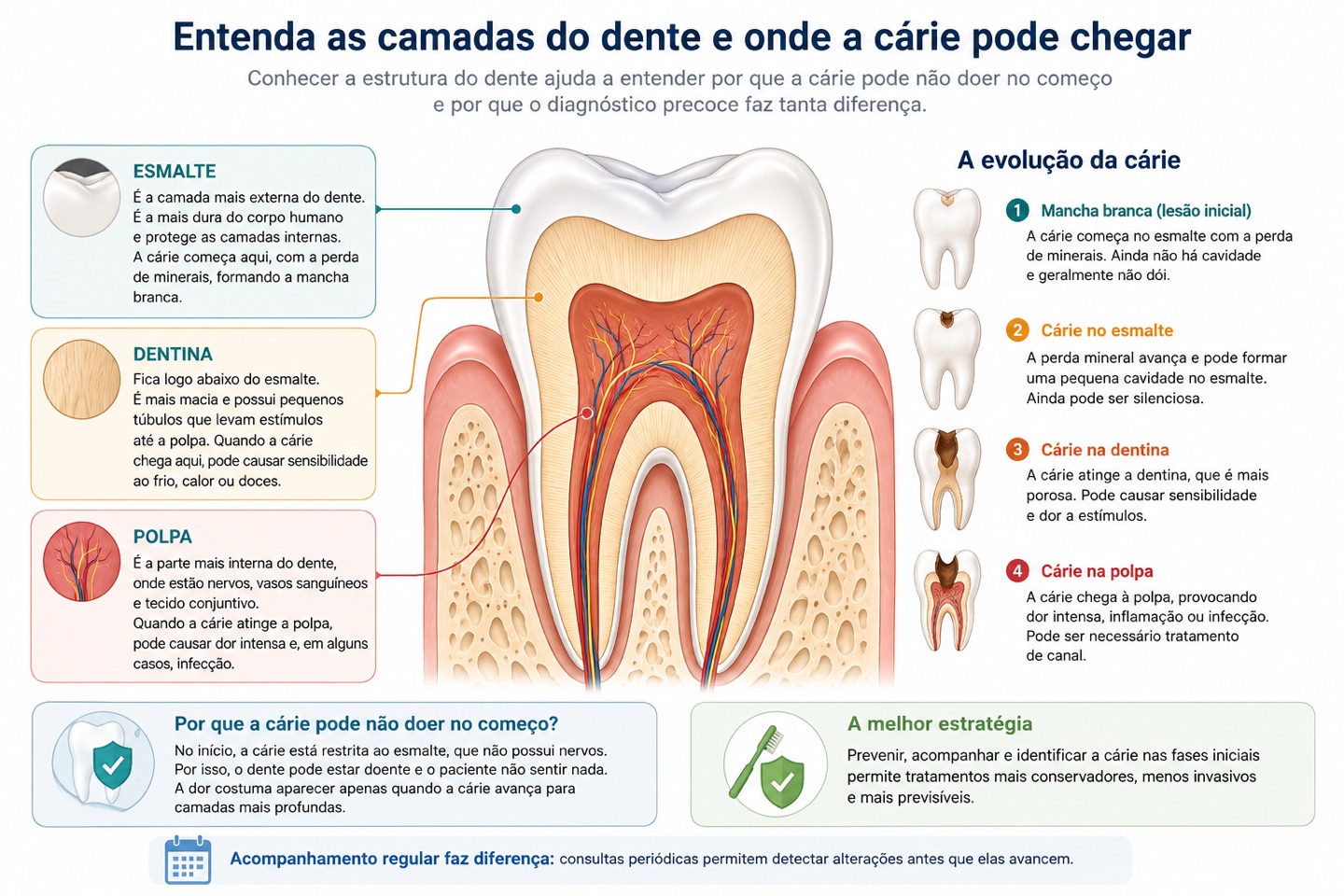 Ilustração das camadas do dente (esmalte, dentina e polpa) e da evolução da cárie em quatro estágios: mancha branca, cárie no esmalte, cárie na dentina e cárie na polpa