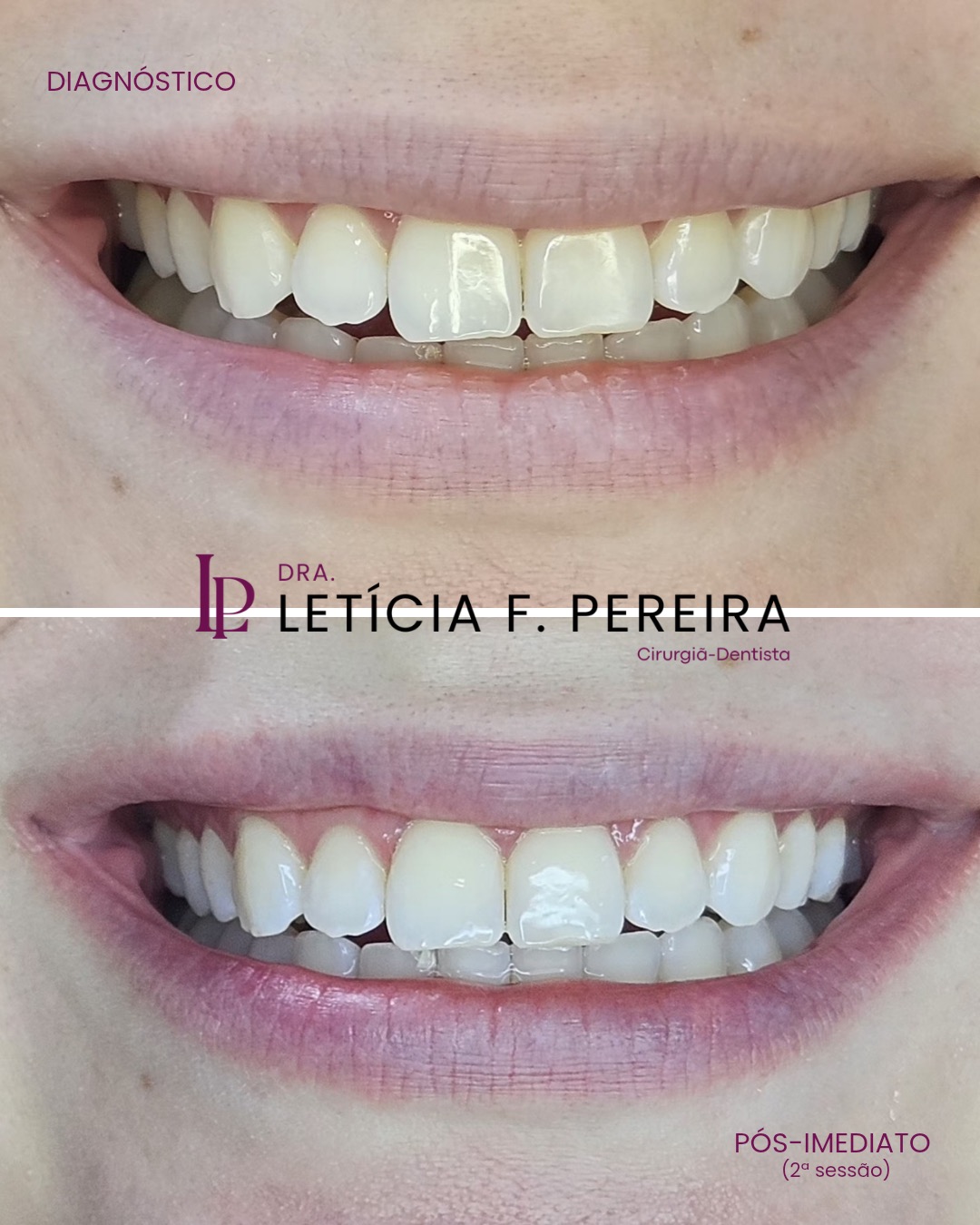 Antes e depois de clareamento dental, renovação do sorriso