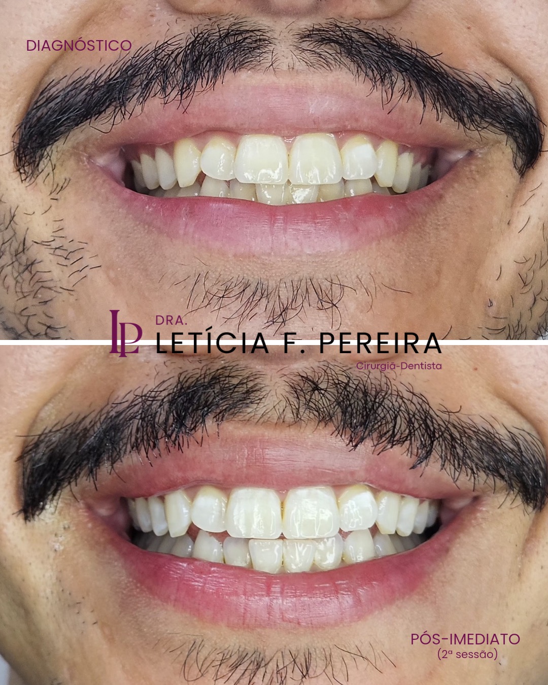 Antes e depois de clareamento dental, agilidade e eficiência