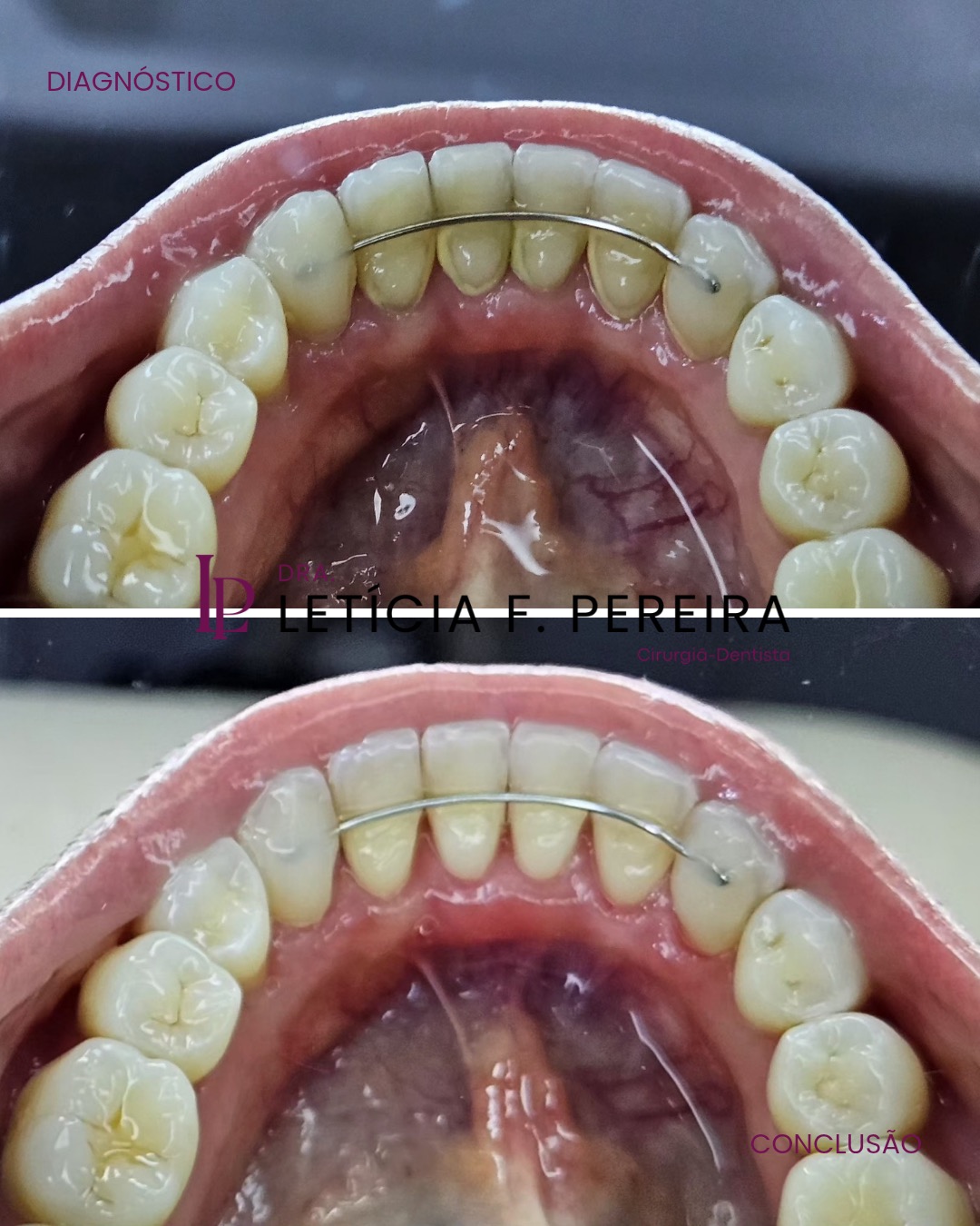 Antes e depois de limpeza profissional em paciente com contenção ortodôntica